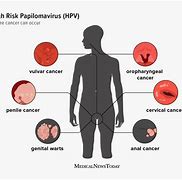 Virus Hpv Dấu Hiệu